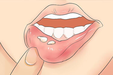 Triệu chứng và cách hỗ trợ điều trị herpes sinh dục ở miệng